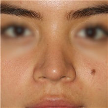 Rhinoplasty After Photo by Luis Bermudez, MD, FACS; Bogota, DC - Case 49563