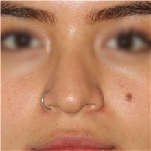 Rhinoplasty Before Photo by Luis Bermudez, MD, FACS; Bogota, DC - Case 49563