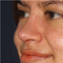 Rhinoplasty After Photo by Luis Bermudez, MD, FACS; Bogota, DC - Case 49610