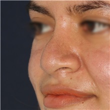 Rhinoplasty Before Photo by Luis Bermudez, MD, FACS; Bogota, DC - Case 49610