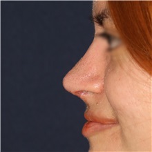 Rhinoplasty After Photo by Luis Bermudez, MD, FACS; Bogota, DC - Case 49610