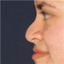 Rhinoplasty Before Photo by Luis Bermudez, MD, FACS; Bogota, DC - Case 49610