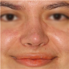 Rhinoplasty After Photo by Luis Bermudez, MD, FACS; Bogota, DC - Case 49610