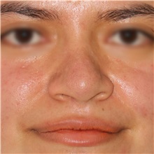 Rhinoplasty Before Photo by Luis Bermudez, MD, FACS; Bogota, DC - Case 49610