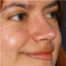 Rhinoplasty After Photo by Luis Bermudez, MD, FACS; Bogota, DC - Case 49610