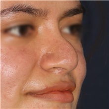 Rhinoplasty Before Photo by Luis Bermudez, MD, FACS; Bogota, DC - Case 49610