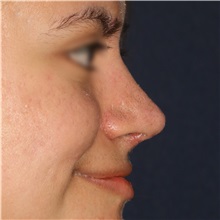 Rhinoplasty After Photo by Luis Bermudez, MD, FACS; Bogota, DC - Case 49610