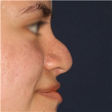 Rhinoplasty Before Photo by Luis Bermudez, MD, FACS; Bogota, DC - Case 49610