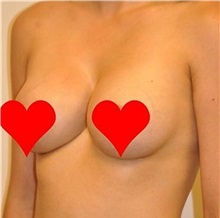 Breast Augmentation After Photo by Roy Kim, MD; San Francisco, CA - Case 31250