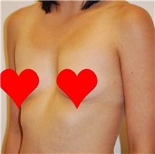 Breast Augmentation Before Photo by Roy Kim, MD; San Francisco, CA - Case 31250