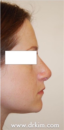 Rhinoplasty After Photo by Roy Kim, MD; San Francisco, CA - Case 31251