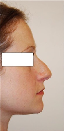 Rhinoplasty Before Photo by Roy Kim, MD; San Francisco, CA - Case 31251