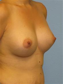 Breast Augmentation After Photo by Mark Jabor, MD; El Paso, TX - Case 29482