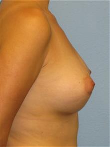 Breast Augmentation After Photo by Mark Jabor, MD; El Paso, TX - Case 29482