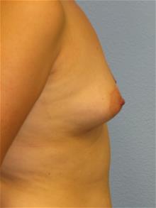 Breast Augmentation Before Photo by Mark Jabor, MD; El Paso, TX - Case 29482