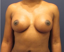 Breast Augmentation After Photo by Michele Shermak, MD; Lutherville Timonium, MD - Case 39865
