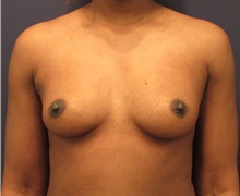 Breast Augmentation Before Photo by Michele Shermak, MD; Lutherville Timonium, MD - Case 39865