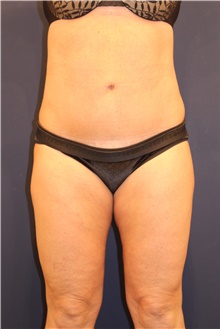 Tummy Tuck After Photo by Michele Shermak, MD; Lutherville Timonium, MD - Case 39948
