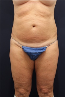 Tummy Tuck Before Photo by Michele Shermak, MD; Lutherville Timonium, MD - Case 39948