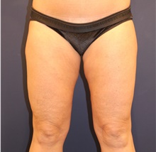 Liposuction After Photo by Michele Shermak, MD; Lutherville Timonium, MD - Case 39950