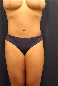 Tummy Tuck After Photo by Michele Shermak, MD; Lutherville Timonium, MD - Case 39961