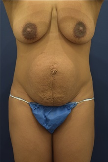 Tummy Tuck Before Photo by Michele Shermak, MD; Lutherville Timonium, MD - Case 39961