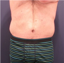 Body Lift After Photo by Michele Shermak, MD; Lutherville Timonium, MD - Case 39971