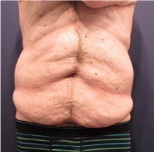 Body Lift Before Photo by Michele Shermak, MD; Lutherville Timonium, MD - Case 39971