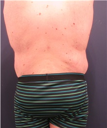 Body Lift After Photo by Michele Shermak, MD; Lutherville Timonium, MD - Case 39971