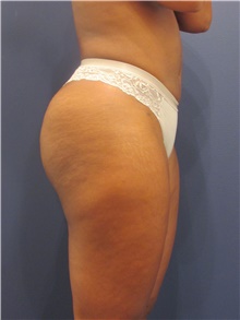 Liposuction After Photo by Michele Shermak, MD; Lutherville Timonium, MD - Case 39973