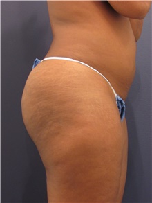 Liposuction Before Photo by Michele Shermak, MD; Lutherville Timonium, MD - Case 39973