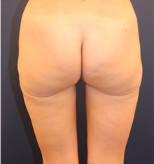 Thigh Lift After Photo by Michele Shermak, MD; Lutherville Timonium, MD - Case 39975