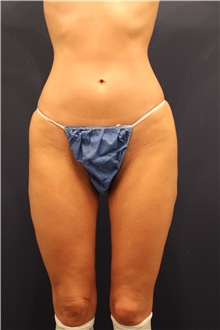 Thigh Lift Before Photo by Michele Shermak, MD; Lutherville Timonium, MD - Case 39975
