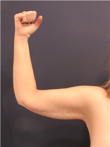 Arm Lift After Photo by Michele Shermak, MD; Lutherville Timonium, MD - Case 39981