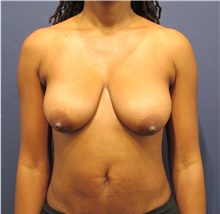 Breast Lift Before Photo by Michele Shermak, MD; Lutherville Timonium, MD - Case 39987