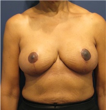 Breast Reduction After Photo by Michele Shermak, MD; Lutherville Timonium, MD - Case 39992