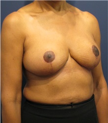 Breast Reduction After Photo by Michele Shermak, MD; Lutherville Timonium, MD - Case 39992