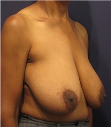 Breast Reduction Before Photo by Michele Shermak, MD; Lutherville Timonium, MD - Case 39992