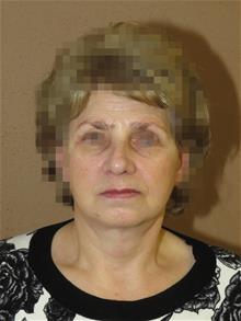 Facelift After Photo by Gregory Turowski, MD; Skokie, IL - Case 28836