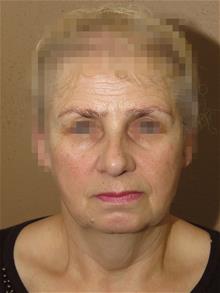 Facelift Before Photo by Gregory Turowski, MD; Skokie, IL - Case 28836