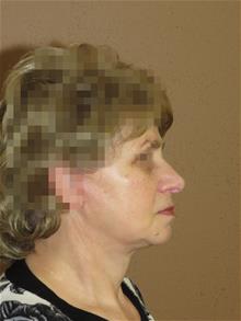 Facelift After Photo by Gregory Turowski, MD; Skokie, IL - Case 28836