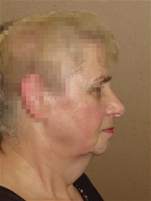 Facelift Before Photo by Gregory Turowski, MD; Skokie, IL - Case 28836