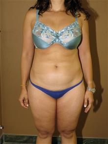 Liposuction Before Photo by Gregory Turowski, MD; Skokie, IL - Case 28842