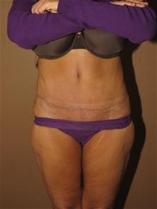 Tummy Tuck After Photo by Gregory Turowski, MD; Skokie, IL - Case 28844