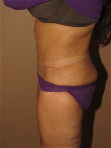 Tummy Tuck After Photo by Gregory Turowski, MD; Skokie, IL - Case 28844
