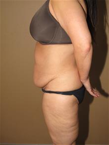 Tummy Tuck Before Photo by Gregory Turowski, MD; Skokie, IL - Case 28844