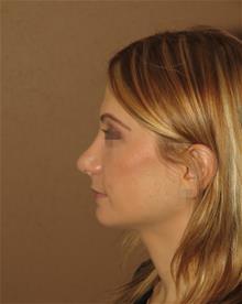 Rhinoplasty After Photo by Gregory Turowski, MD; Skokie, IL - Case 29163