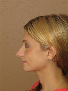 Rhinoplasty Before Photo by Gregory Turowski, MD; Skokie, IL - Case 29163
