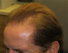 Hair Transplant After Photo by Gregory Turowski, MD; Skokie, IL - Case 29274