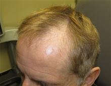 Hair Transplant Before Photo by Gregory Turowski, MD; Skokie, IL - Case 29274